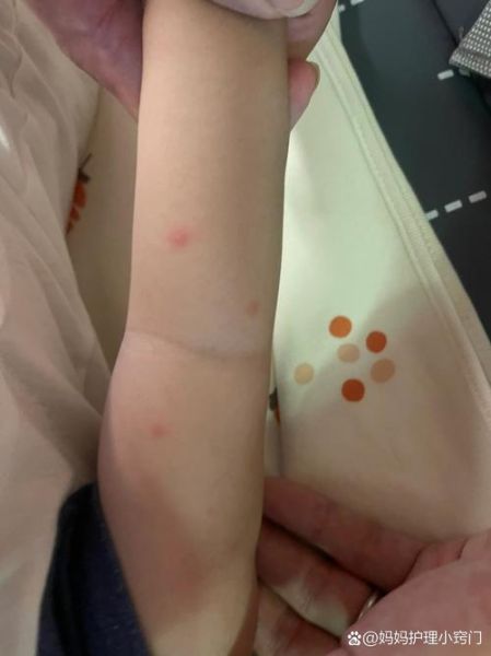 宝宝身上长包怎么回事_宝宝身上长包怎么办