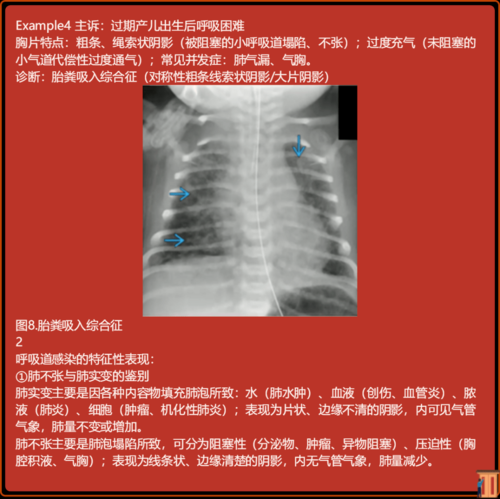 宝宝胸片怎么看_拍胸片对婴儿有影响吗