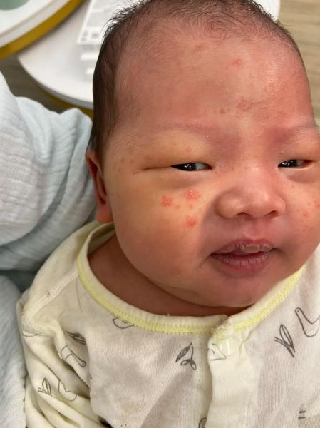 宝宝两边脸颊长小红点_怎么办