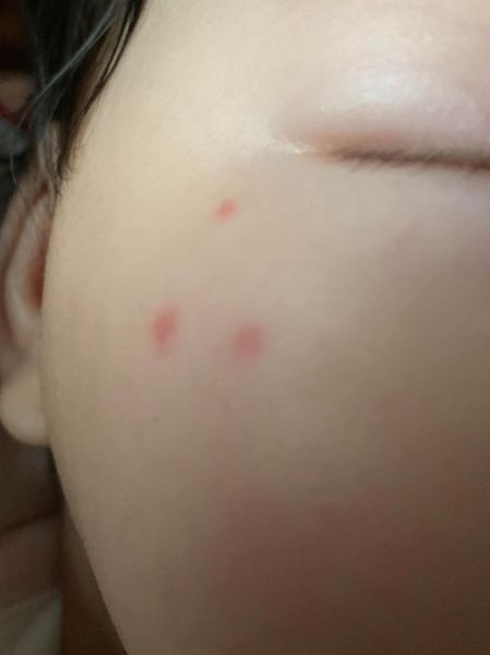 宝宝两边脸颊长小红点_怎么办