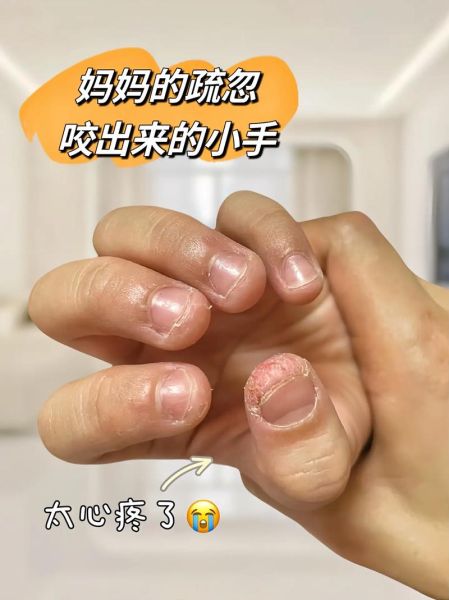 宝宝咬手指甲怎么回事_宝宝咬指甲缺什么