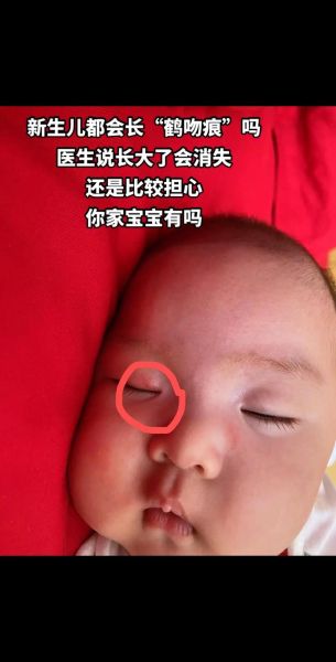 宝宝脸上红色胎记怎么去除_宝宝红色胎记会自己消失吗