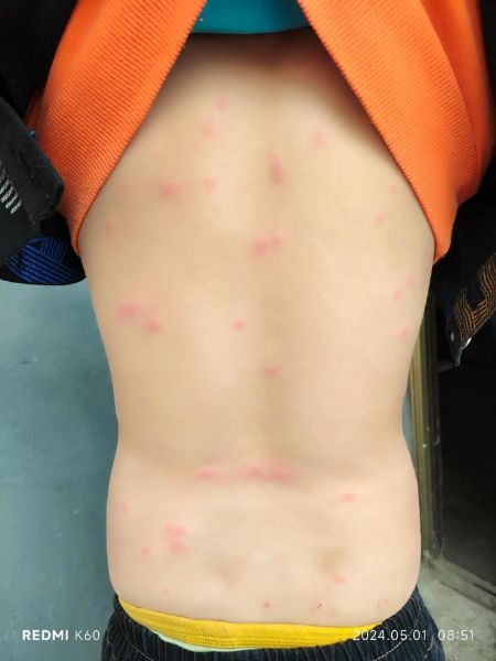 七个月宝宝起红疙瘩图_宝宝红疙瘩怎么办