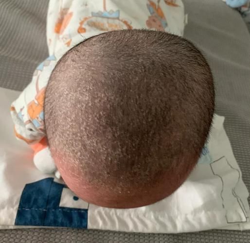 宝宝头皮有白斑图片_宝宝头皮白斑是白癜风吗
