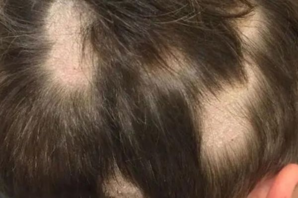 宝宝头皮有白斑图片_宝宝头皮白斑是白癜风吗