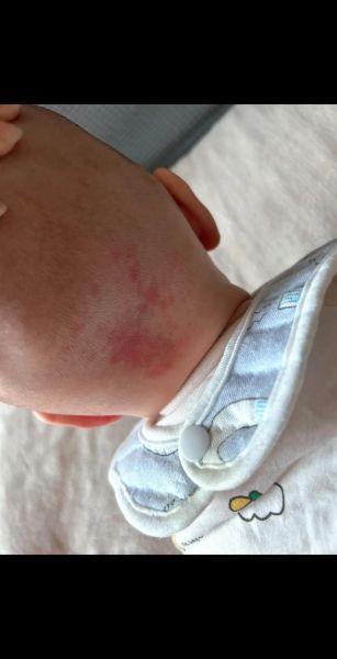 宝宝后脑勺鹤吻痕图片_新生儿红斑多久消退