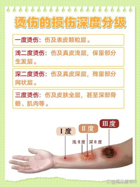 烫伤图片大全_烫伤后怎么处理不留疤