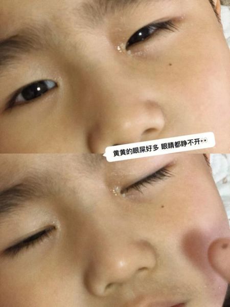 宝宝眼睛发炎怎么办_宝宝眼睛发炎图片怎么看