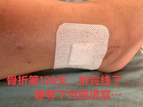 梦见自己骨折是什么意思_骨折梦境预示什么