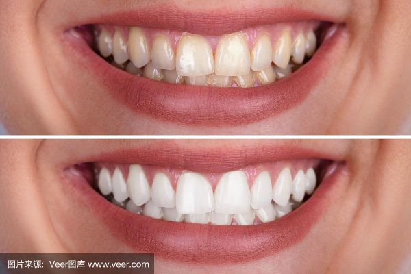 美牙图片大全_美牙前后对比真实案例