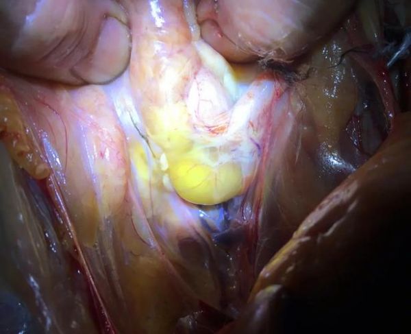 宝宝小鸡里有囊肿图片_会不会自己消