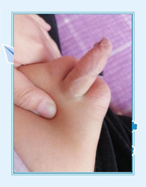 宝宝小鸡里有囊肿图片_会不会自己消