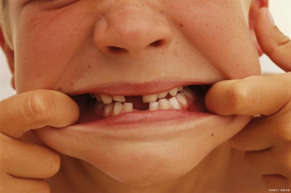 宝宝牙齿缺口怎么回事_宝宝牙齿缺口怎么办