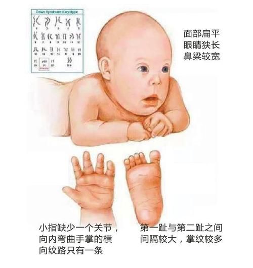 唐氏宝宝能活多久_唐氏宝宝有哪些特征