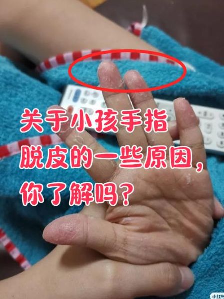 3岁宝宝手指脱皮是怎么回事_宝宝手指脱皮怎么办