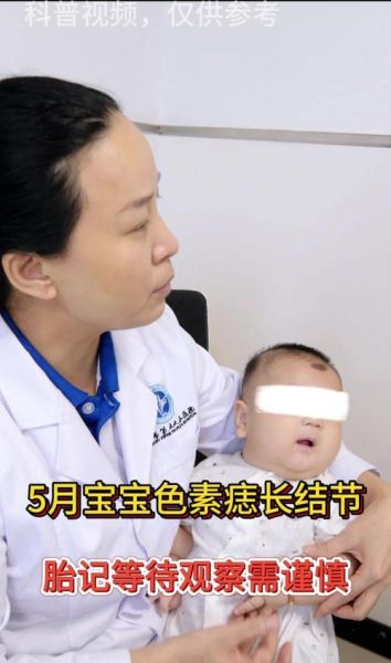 宝宝黑色素痣会癌变吗_什么时候必须切除