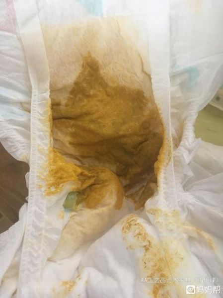宝宝大便有水怎么办_新生儿拉稀水便正常吗