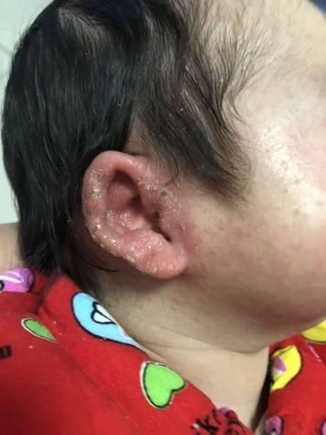 两个月宝宝耳朵进水了怎么办_婴儿耳朵进水会发炎吗