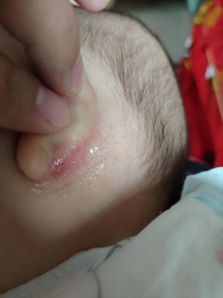 宝宝耳垂下边裂口怎么办_婴儿耳垂裂口护理方法