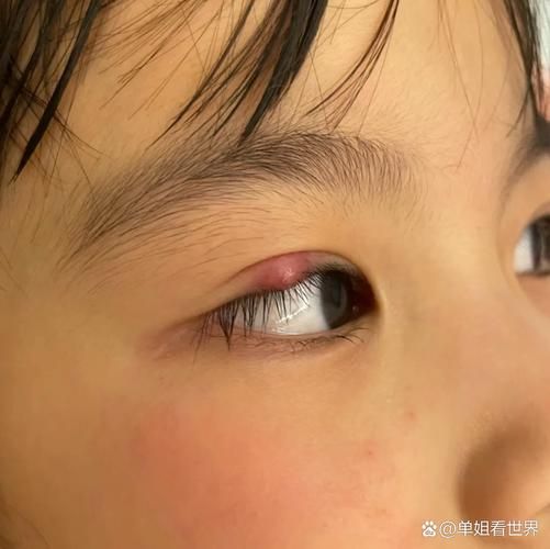 宝宝早上起床眼睛肿怎么回事_宝宝眼睛肿怎么快速消肿