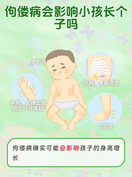 宝宝佝偻病早期症状有哪些_佝偻病怎么治疗最好