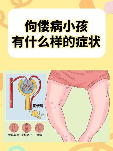 宝宝佝偻病早期症状有哪些_佝偻病怎么治疗最好