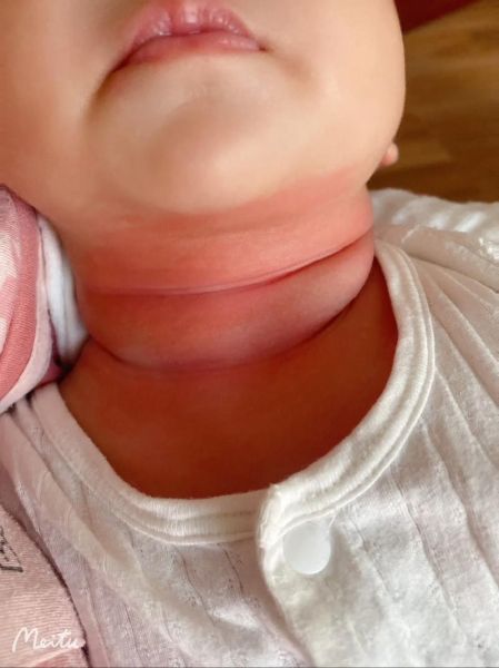 宝宝身上起红色大片_怎么办