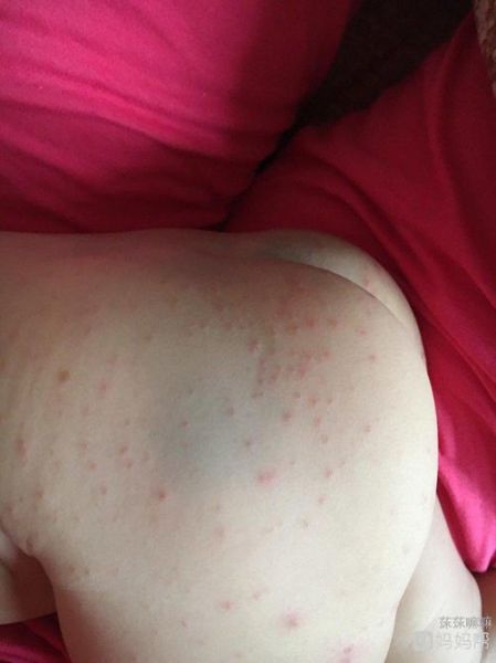 宝宝身上起红色大片_怎么办