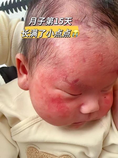 宝宝发丹的症状图片_宝宝发丹初期图片