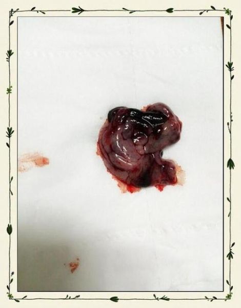 梦到自己流产了_是什么意思