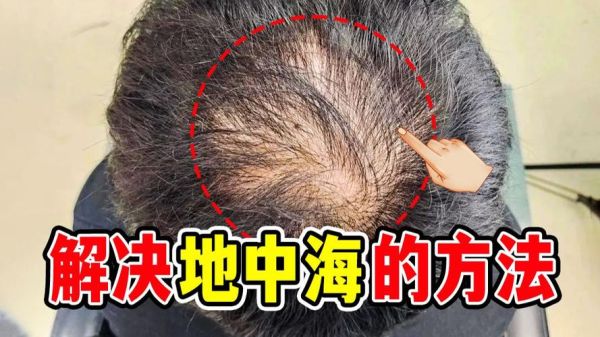 梦到发际线后移是什么意思_梦见头发变少怎么办