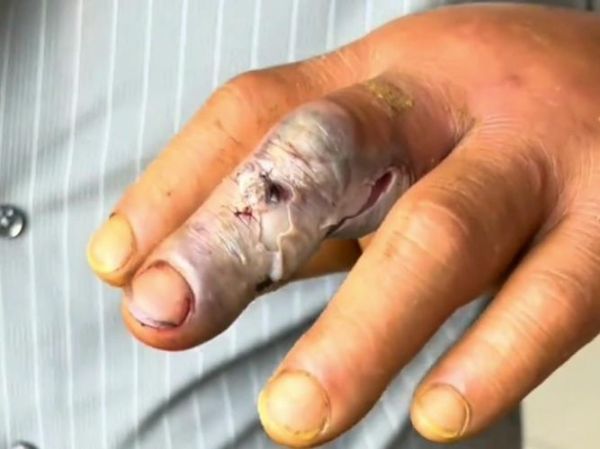 梦到被毒蛇咬到手中毒_是什么意思