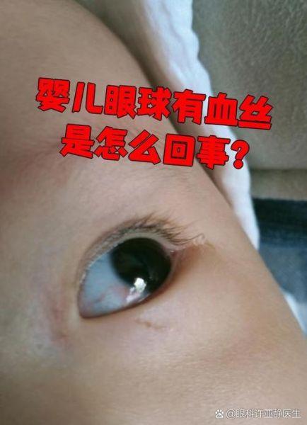 6个月宝宝眼睛有红血丝_怎么办
