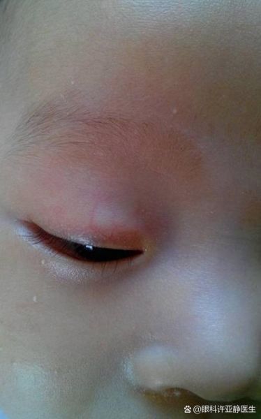 6个月宝宝眼睛有红血丝_怎么办