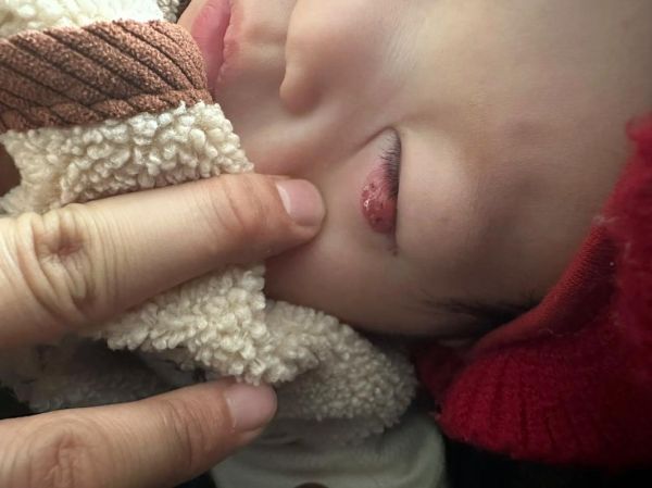 宝宝眼皮上长了个小疙瘩是怎么回事_需要看医生吗