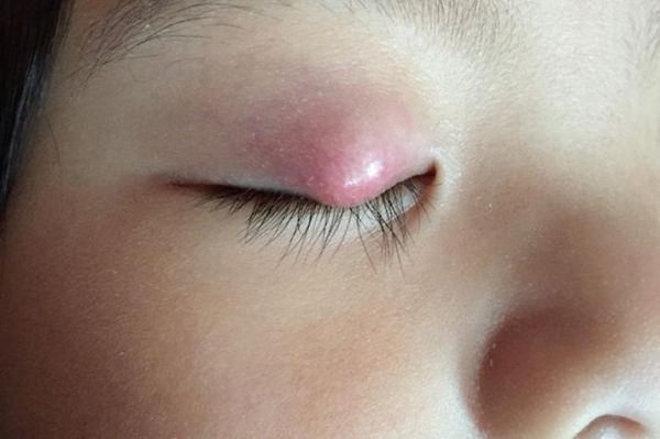 宝宝眼皮上长了个小疙瘩是怎么回事_需要看医生吗