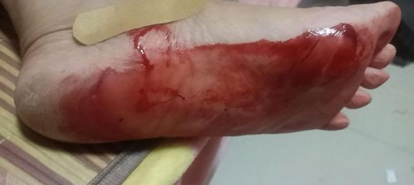 梦到脚破了_是什么意思