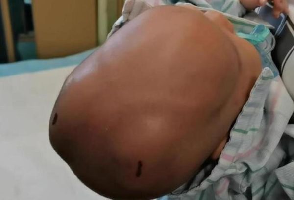 宝宝头皮血肿多久能消_需要抽吸吗