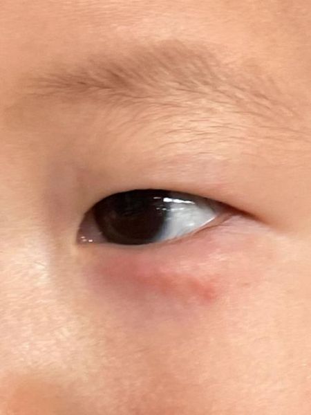 宝宝眼角长红疙瘩是怎么回事_怎么处理