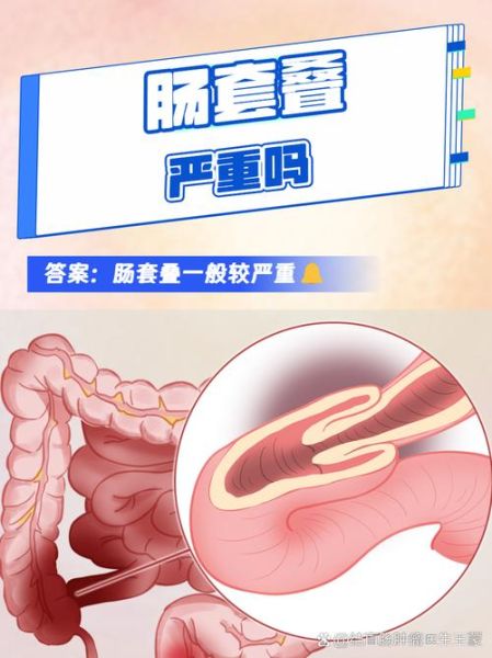 肠套叠宝宝大便图片_果酱样便是唯一信号吗