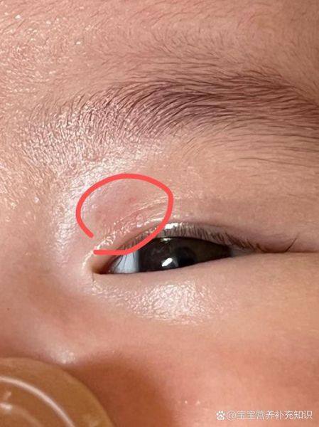 宝宝眼角长红疙瘩是怎么回事_怎么处理