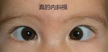 宝宝对眼怎么判断_婴儿对眼正常吗