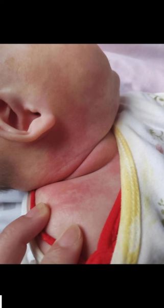 宝宝湿疹多久能好_婴儿湿疹一般几个月消退