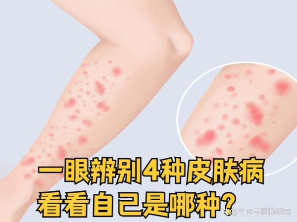 皮肤图片大全_如何辨别常见皮肤病