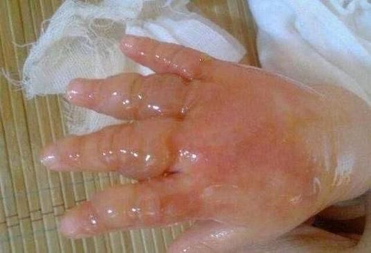 梦到被火烧伤是什么意思_梦到被火烧伤预示什么