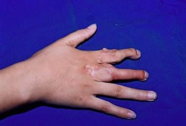 梦到手断了_梦见手断了是什么意思