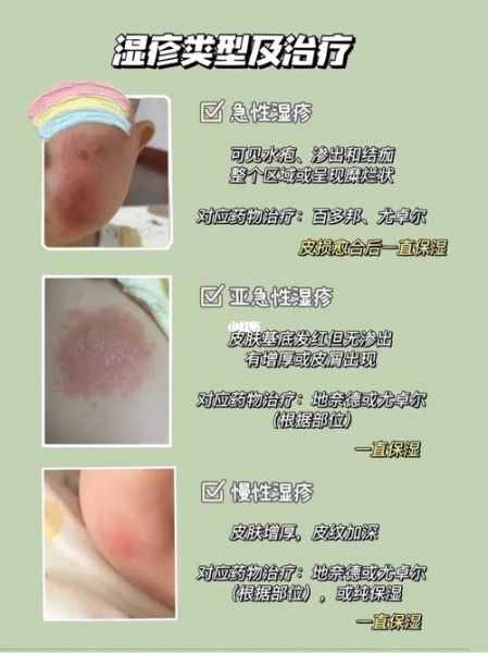 宝宝过敏湿疹反复怎么办_日常护理全攻略