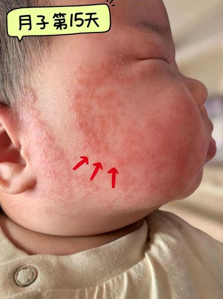 宝宝脸上红斑怎么回事_新生儿红斑多久能好