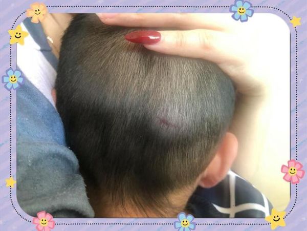 四岁宝宝摔到后脑勺怎么办_需要去医院吗