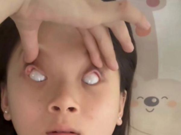 宝宝眼睛往上翻白眼是怎么回事_新生儿翻白眼正常吗